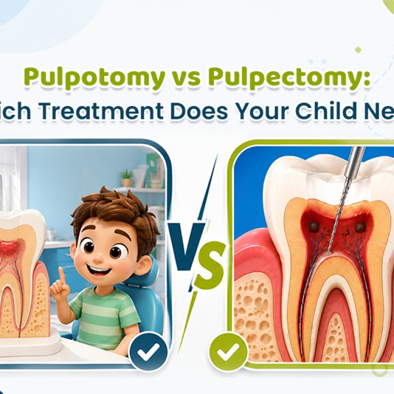 Pulpotomy vs Pulpectomy: Comparing Treatments for Children